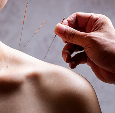 Acupuncture
